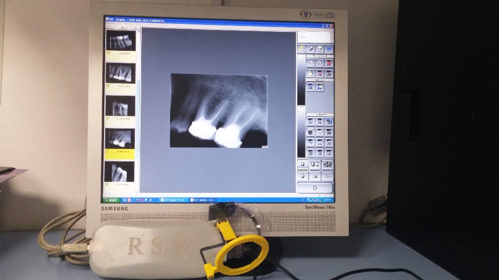 Digitalno retroalveolarno snimanje zuba